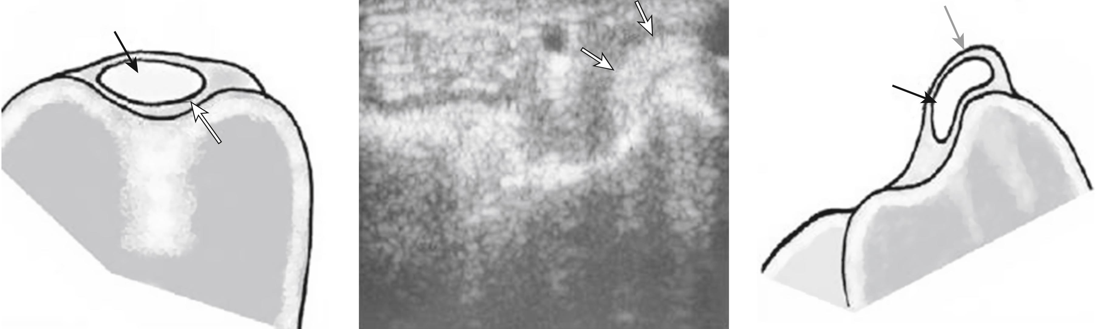 eFig. 14.2, Dynamic ultrasound of the wrist. With the wrist in supination, the extensor carpi ulnaris (ECU) tendon (arrows) subluxates out of the distal ulnar groove in an ulnar and volar direction. Illustration of ultrasound image: The ECU tendon (black arrow) subluxates out of the groove but remains within the sheath (gray arrow) .
