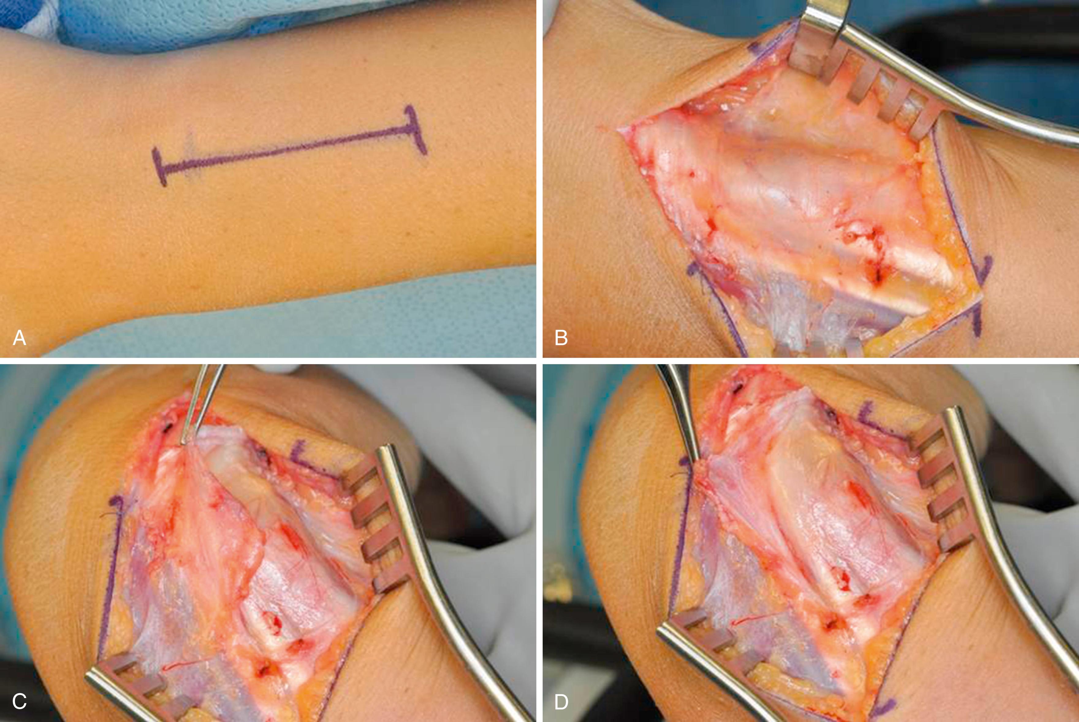 eFig. 14.3, A to D, 5-cm dorsoulnar incision; retinaculum incised and reflected radialward to expose extensor carpi ulnaris subsheath and ulna.