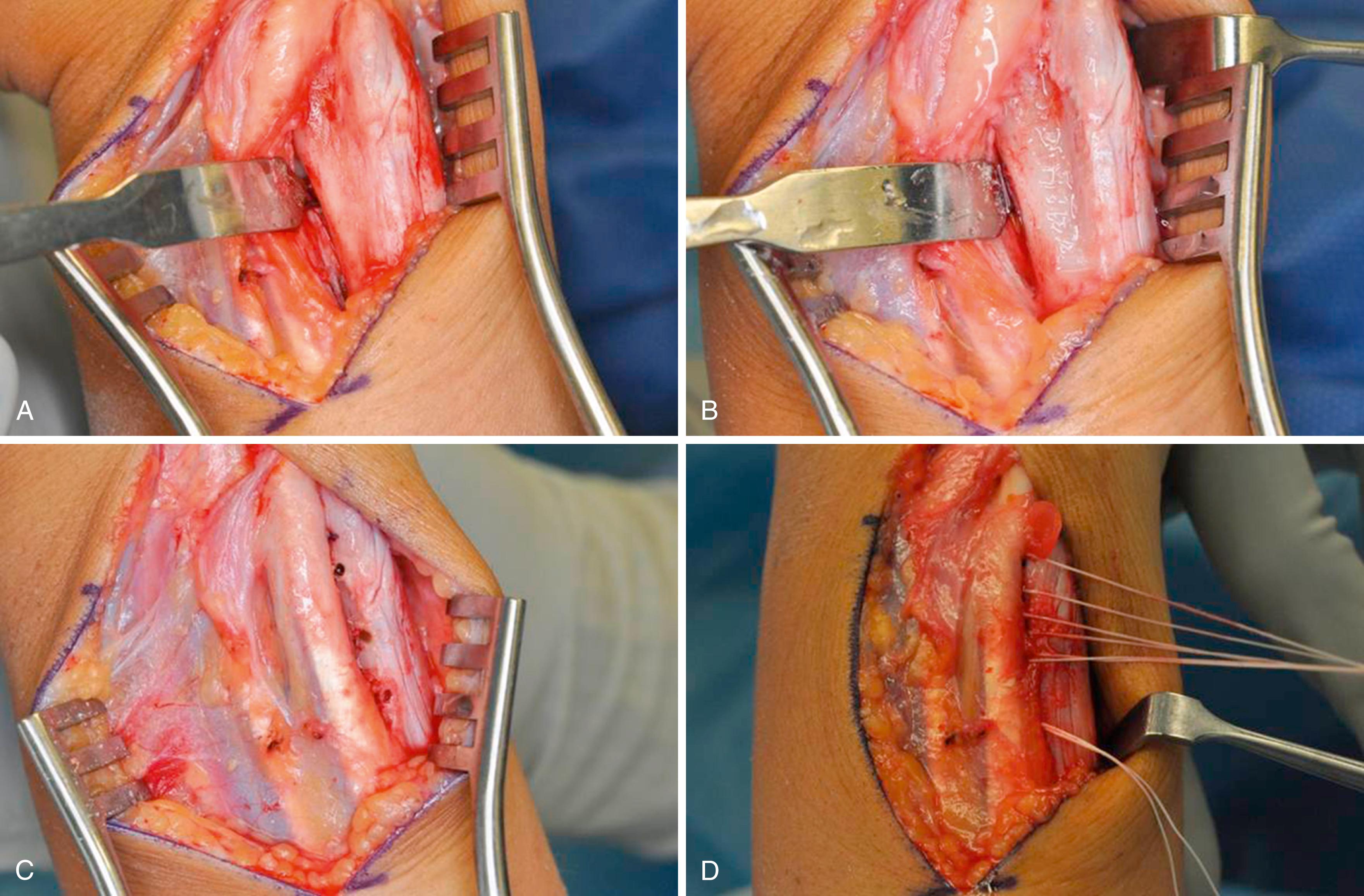 eFig. 14.4, A, Bennett retractor in interosseous space. B, Demonstrates extensor carpi ulnaris (ECU) groove (not deepened). C, Drill holes on ulnar side, multiple suture anchors placed. D, ECU subsheath imbricated and tied down.