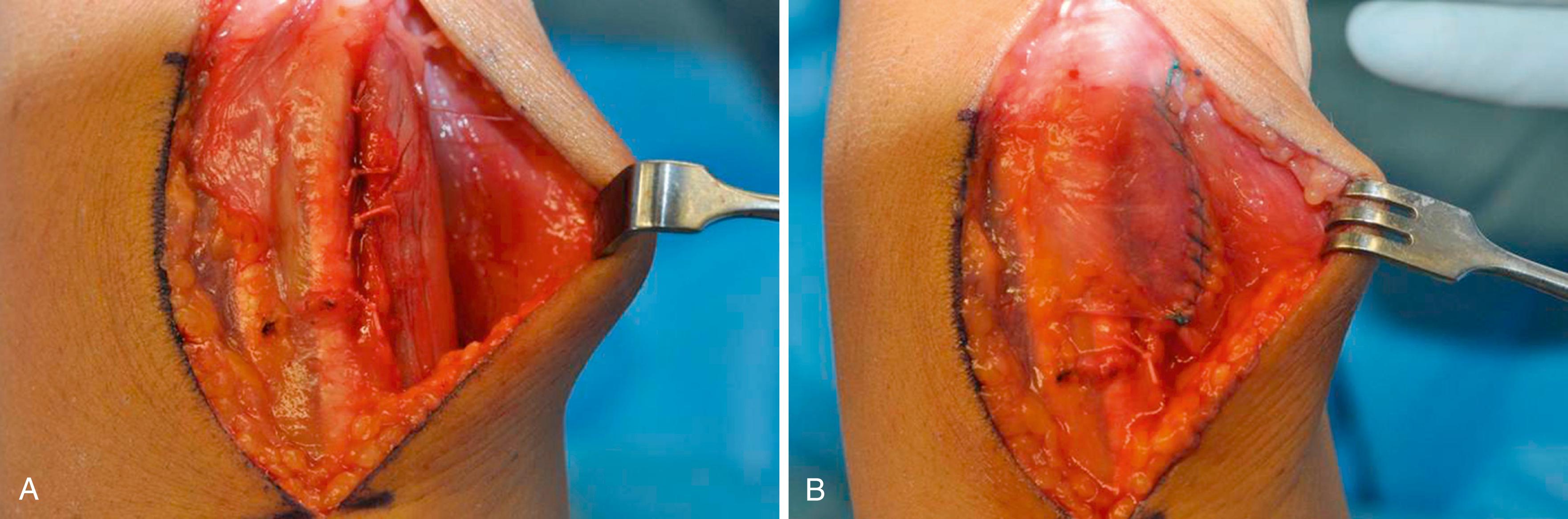 eFig. 14.5, A and B, Sheath successfully imbricated. Retinacular flap securely repaired. Follow-up with 4 weeks in a long-arm cast, 4 weeks short-arm cast, and 4 weeks splint and range-of-motion exercises.