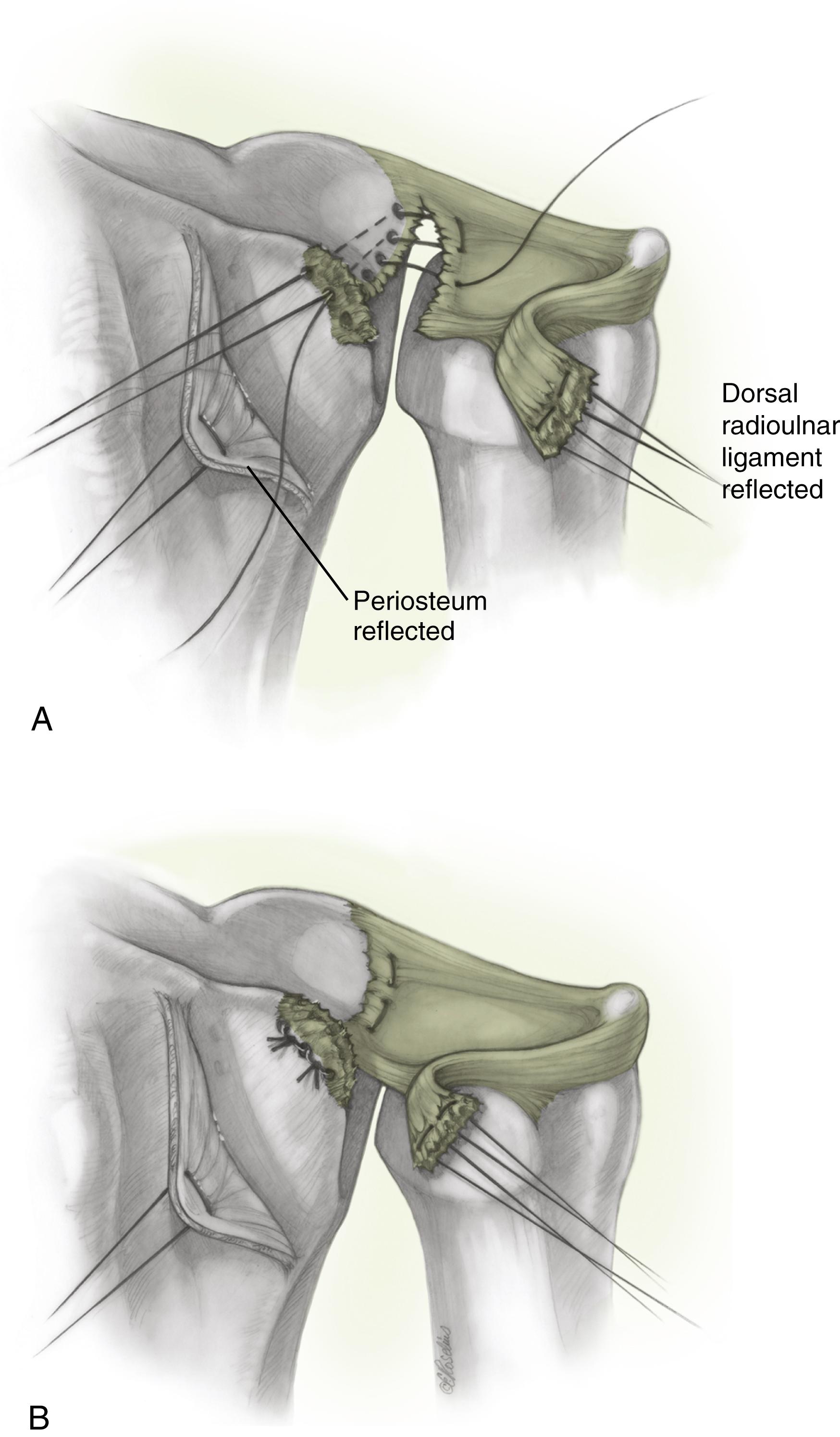 Fig. 14.15, A and B, Class 1D injury involving dorsal radioulnar ligament can be repaired by an open technique using transosseous sutures.