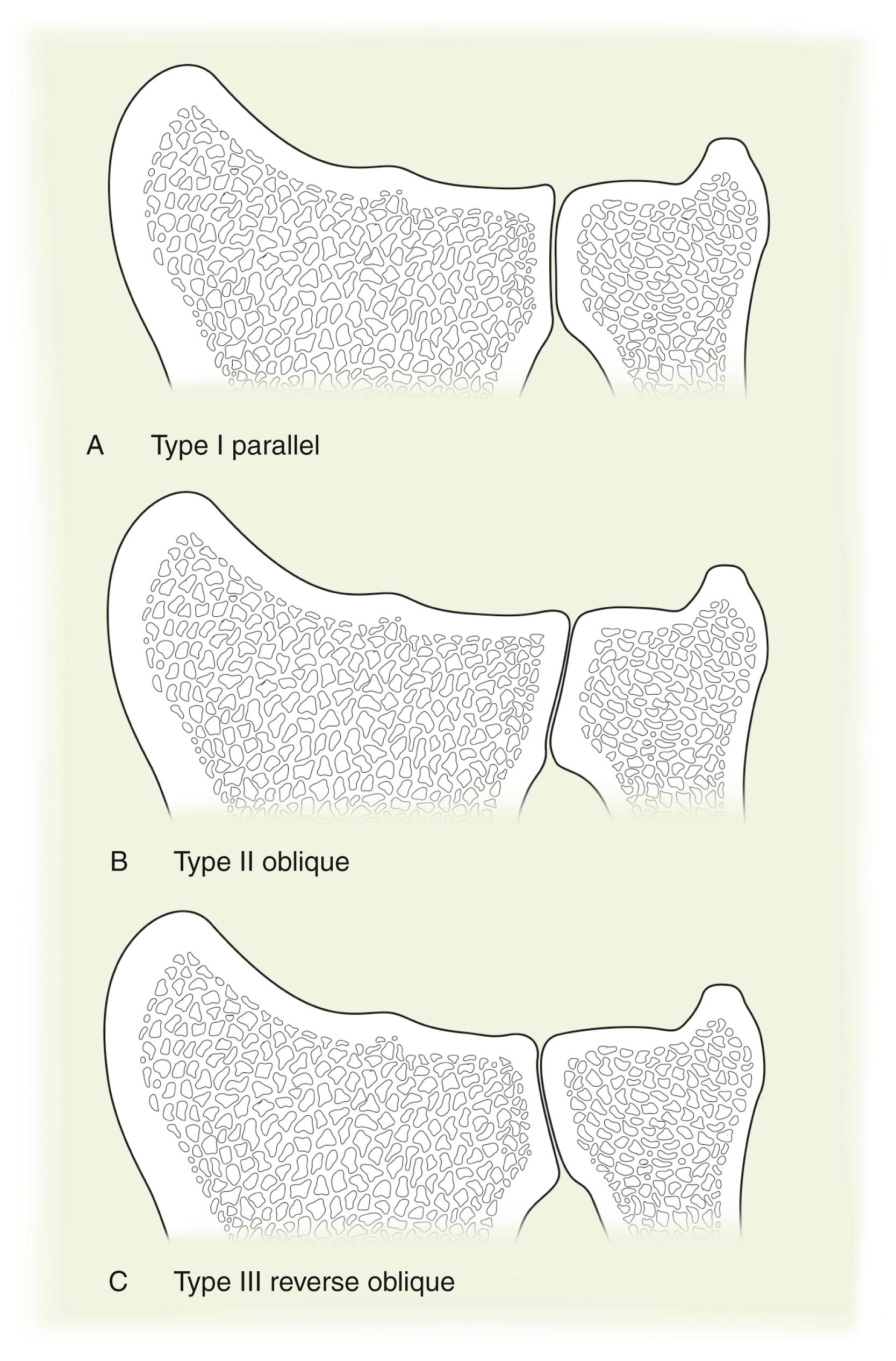 Fig. 14.3, Three morphologies of the articular surfaces of the distal radial ulnar joint are described in the coronal plane. Type I parallel (A) , Type II oblique (B) , and Type III reverse oblique (C) slopes of the DRUJ.