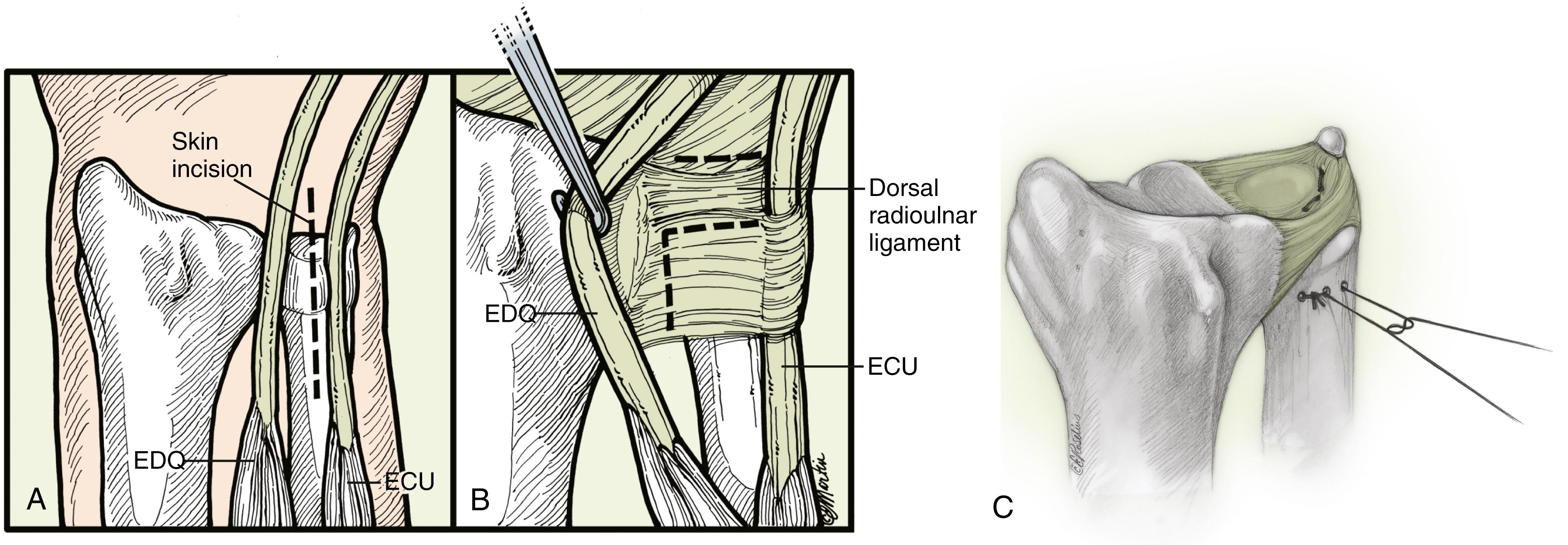 Fig. 14.16, A to C, Open repair of class IB tear is performed through a dorsal approach, “L”-shaped capsulotomy, and horizontal transosseous mattress sutures through the ulnar neck. ECU, Extensor carpi ulnaris; EDM, extensor digiti minimi.