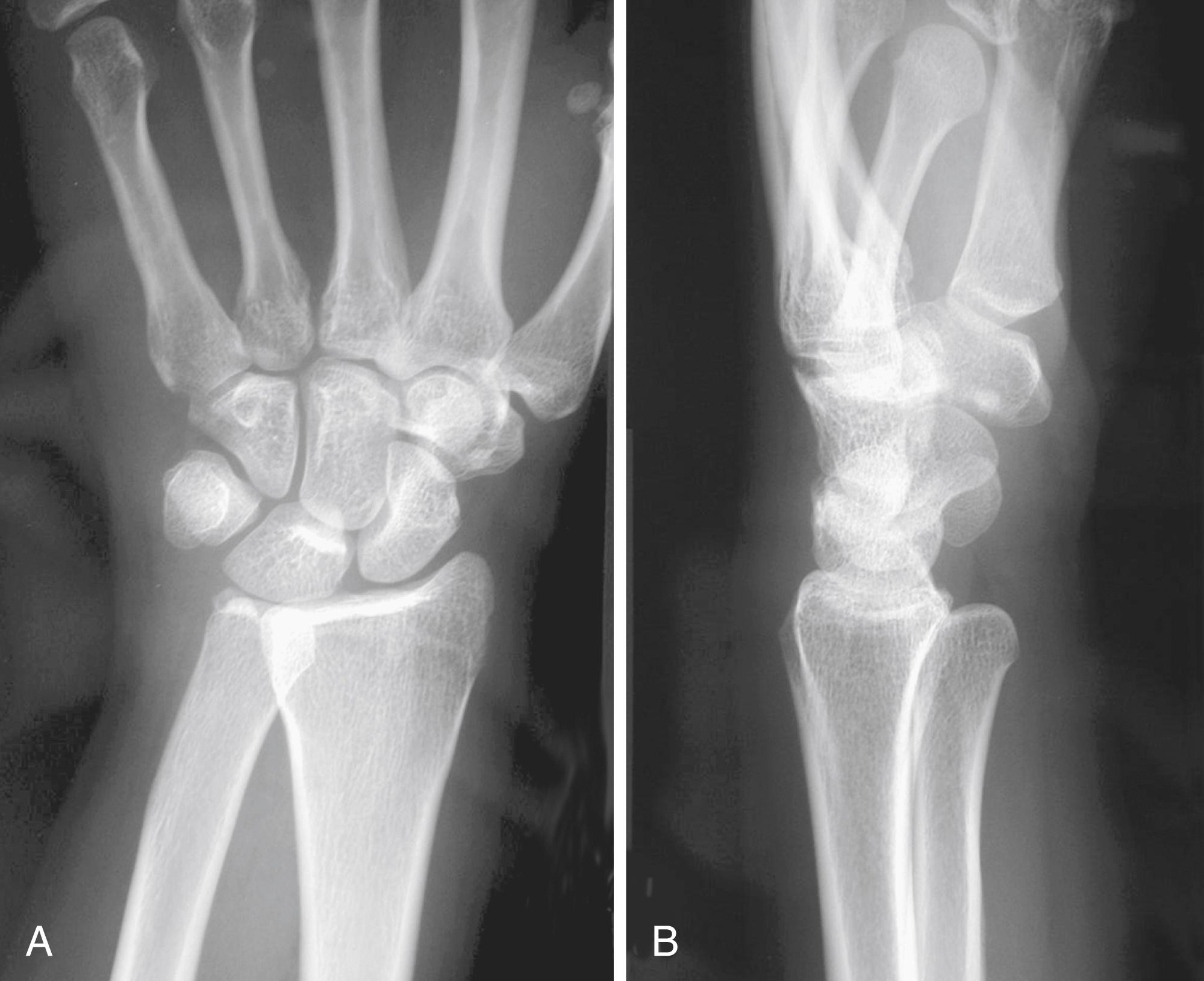 Fig. 14.17, Radiograph of volar dislocation of distal radial ulnar joint shows overlap of ulnar head and sigmoid notch on posteroanterior view (A) and volar displacement of ulnar head on lateral view (B) .