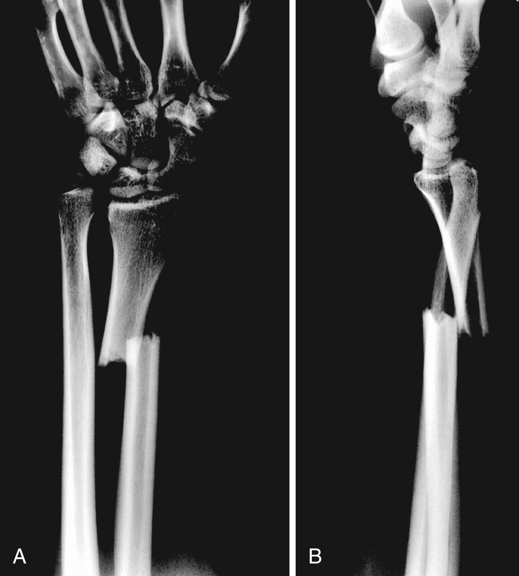 Fig. 14.18, A and B, Galeazzi fracture disrupts distal radial ulnar joint (DRUJ) to varying degrees. After anatomic reduction of the radius, DRUJ stability is assessed and treated if necessary.