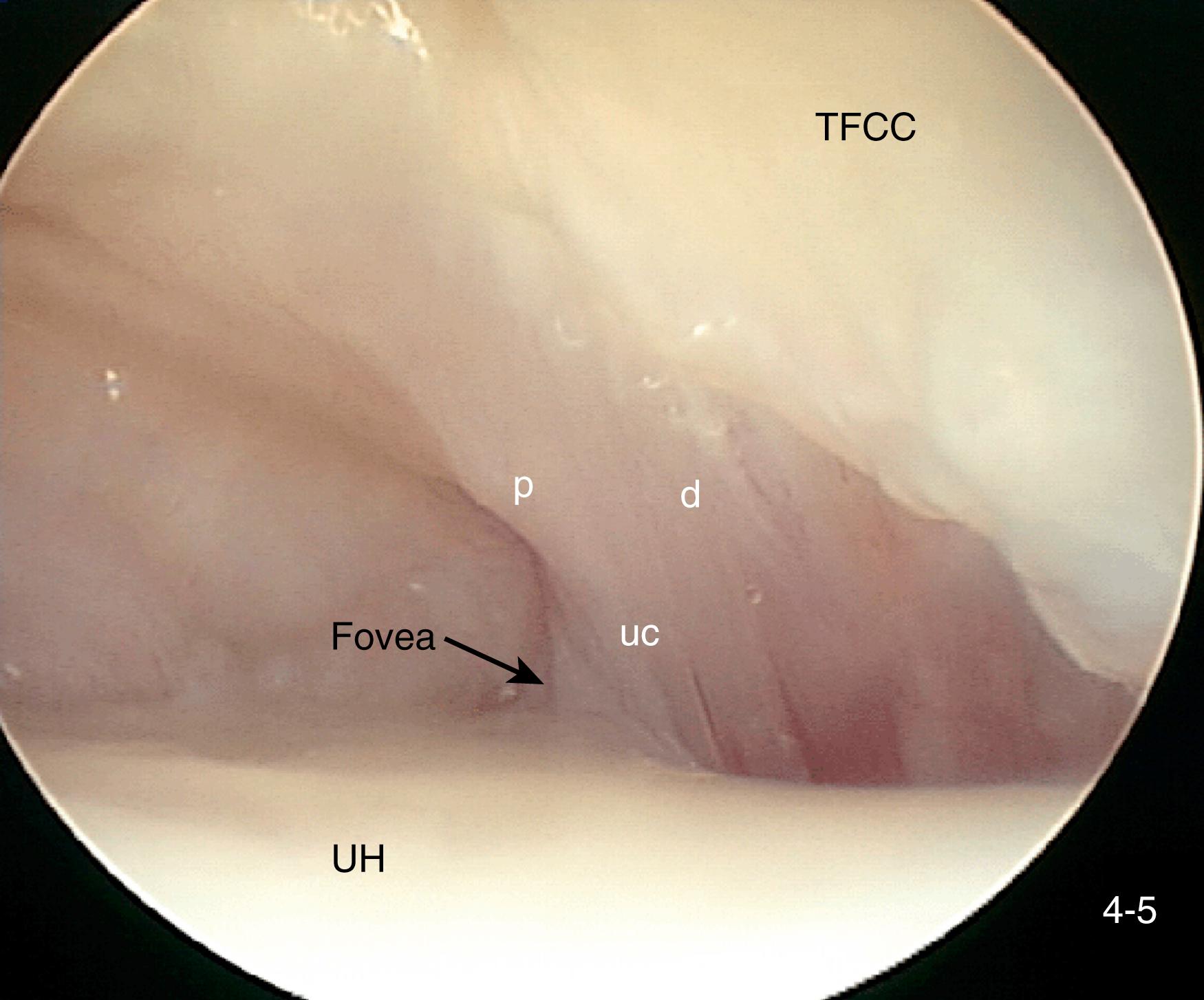 Fig. 14.5, Arthroscopic evaluation of the ulnocarpal joint in the interval between the triangular fibrocartilage complex (TFCC) and ulnar head (UH). The inserting fibers of the deep limbs of the palmar (p) and dorsal (d) radioulnar ligaments converge as they insert into the foveal region of the distal ulna. The ulnar collateral ligament (uc) is considered a capsular condensation along the midsagittal aspect of the ulnocarpal joint.