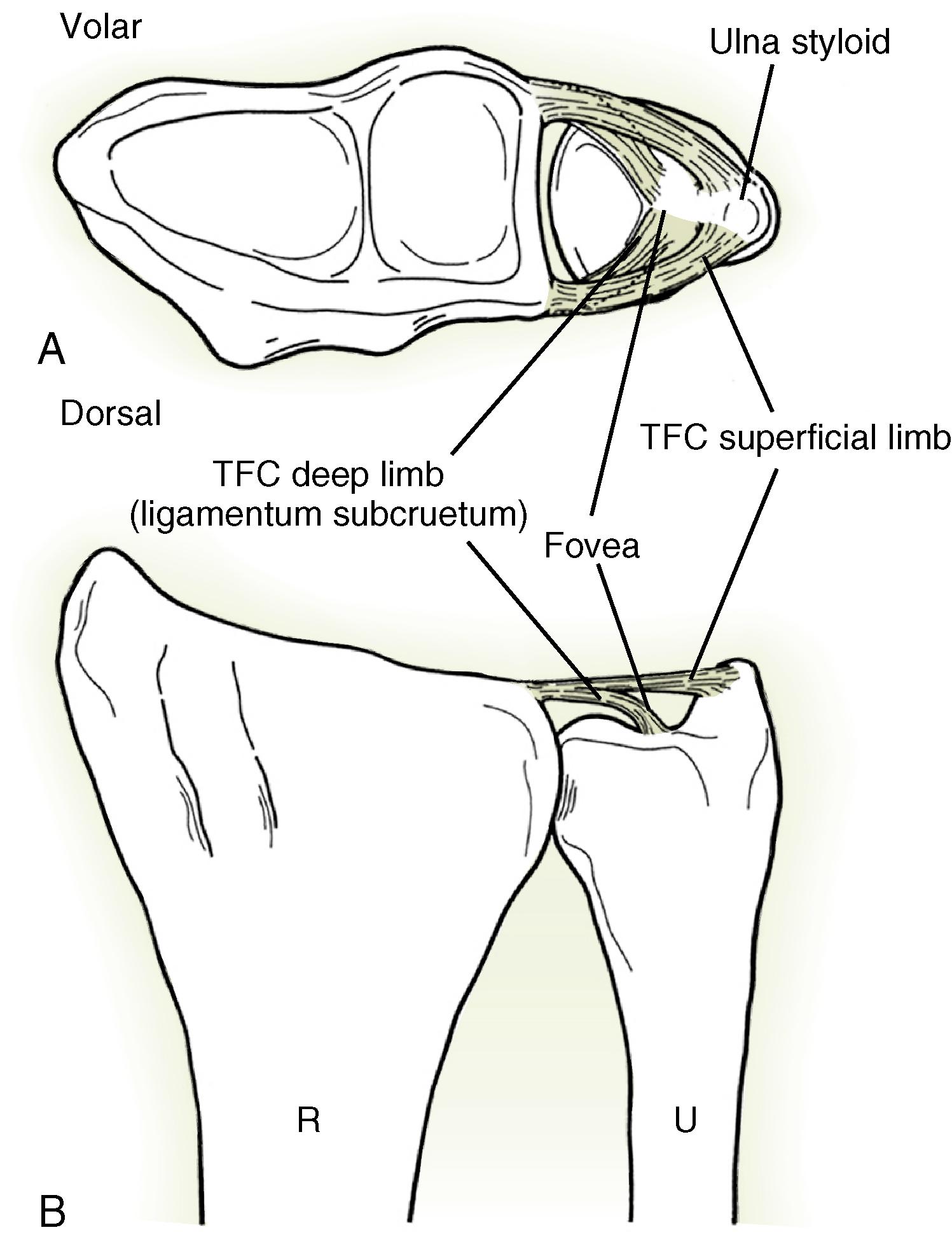 Fig. 14.6, A and B, Normal division of dorsal and palmar radioulnar ligaments into superficial (distal) limbs that attach to the ulnar styloid and deep (proximal) limbs that attach at the fovea of the ulnar head. R, Radius; TFC, triangular fibrocartilage; U, ulna.