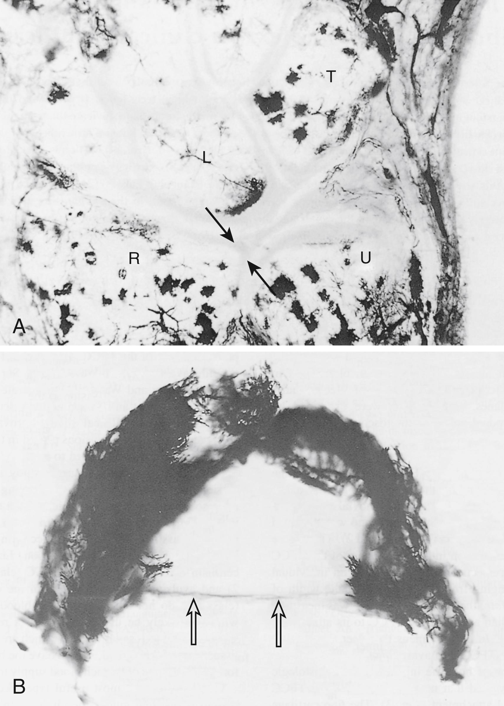 Fig. 14.8, Triangular fibrocartilage complex (TFCC) is well vascularized in its periphery, whereas only the outer 15% of the disk has vascular penetration. Arrows in (A) and (B) identify avascular regions of TFCC at its attachment to radius. A, Coronal section through wrist. B, Axial view of TFCC. L, Lunate; R, radius; T, triquetrum; U, ulna.