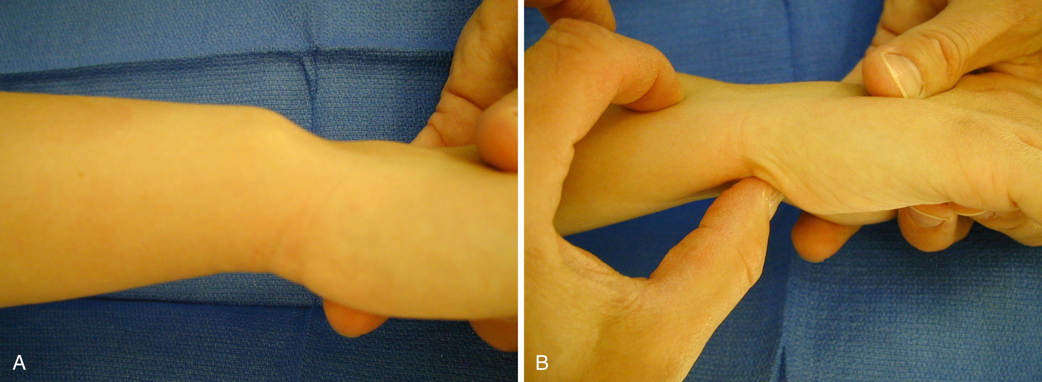 Fig. 14.9, A, Appearance of the right distal ulnar forearm and wrist demonstrating the dorsal prominence of the ulnar head associated with volar subluxation of the distal radius and carpus. B, The examiner is able to reduce the wrist by placing the index and long fingers on the dorsal distal ulna and using the thumb to apply a dorsally directed force on the pisiform.