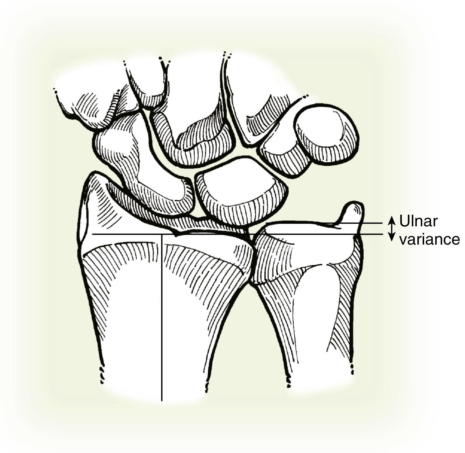 Fig. 14.10, Ulnar variance is measured by drawing a line through the volar sclerotic line of the distal radius perpendicular to its longitudinal axis. Variance is the distance between this line and the distal cortical rim of the ulnar dome.
