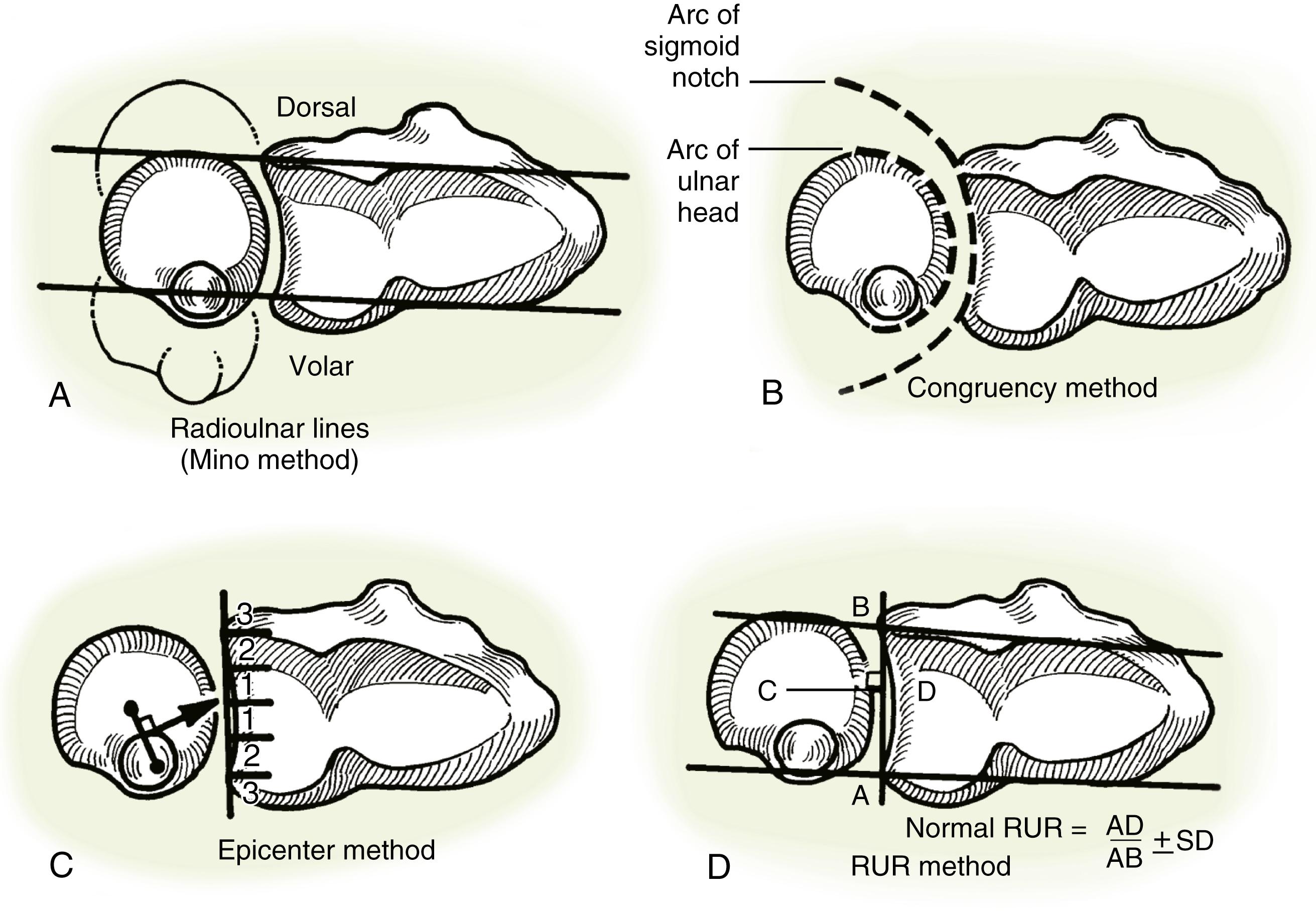Fig. 14.11, Measurement methods for assessing distal radial ulnar joint instability on axial computed tomography images. A, Radioulnar lines (Mino method). B, Congruency method. C, Epicenter method. D, Radioulnar ratio (RUR) method.