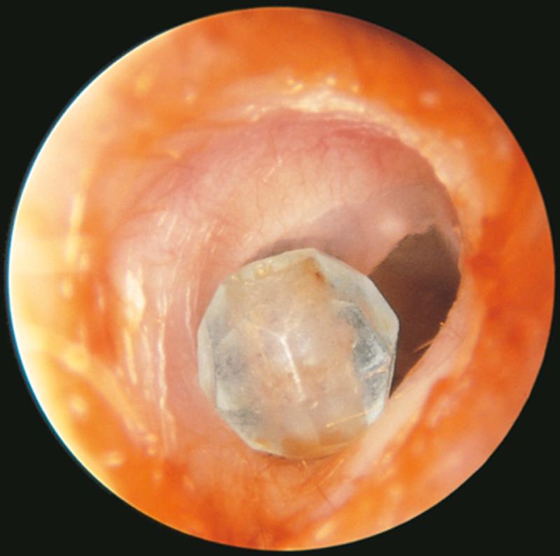 Fig. 11.10, Clear Plastic Bead in the External Ear Canal.