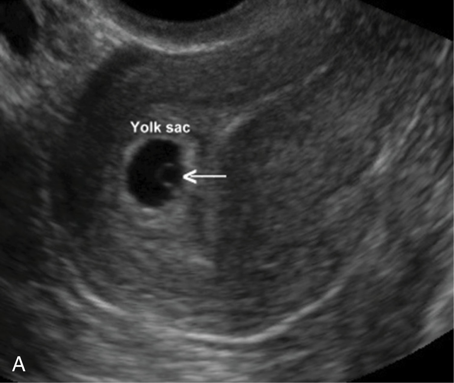 Fig. 49.3, The secondary yolk sac is the yolk sac seen sonographically throughout the first trimester.