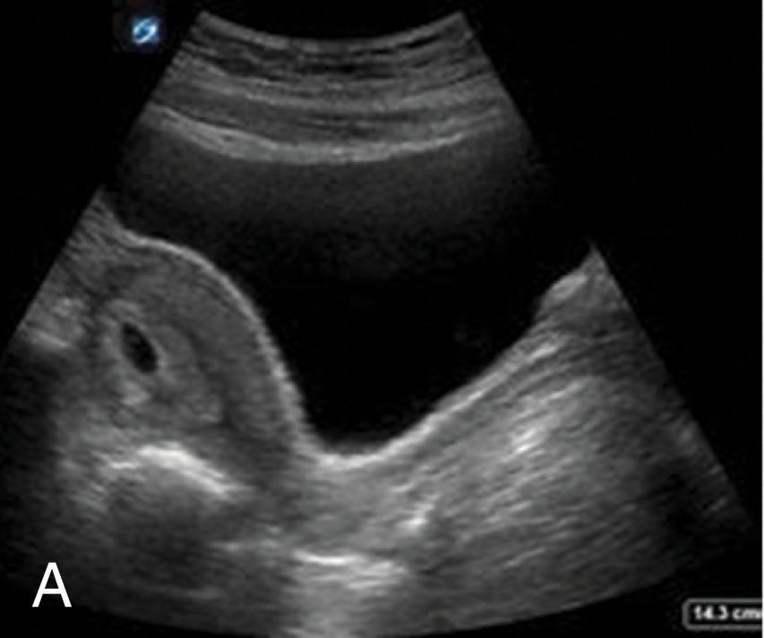 Fig. 49.6, (A) In many labs, the transabdominal approach is used first while the patient has a full bladder. (B) This is followed by the detailed transvaginal exam after the bladder is completely emptied.