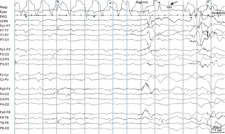 Figure 13-12, An example of active sleep is shown. Note the low-voltage irregular (LVI) pattern in which overall voltages are low save for examples of superimposed motion artifact. The respiratory (top) channel shows irregular respirations and a brief respiratory pause (arrow), consistent with active sleep. The oculogram (second channel) shows sharp deflections representing horizontal rapid eye movement of sleep (dots), the hallmark of active sleep.