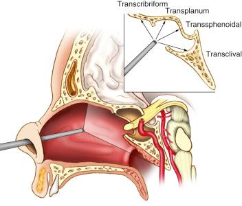 Figure 12.1, Schematic drawing showing the range of the endoscopic endonasal approach, providing access to the entire ventral skull base, with different modules of approach.