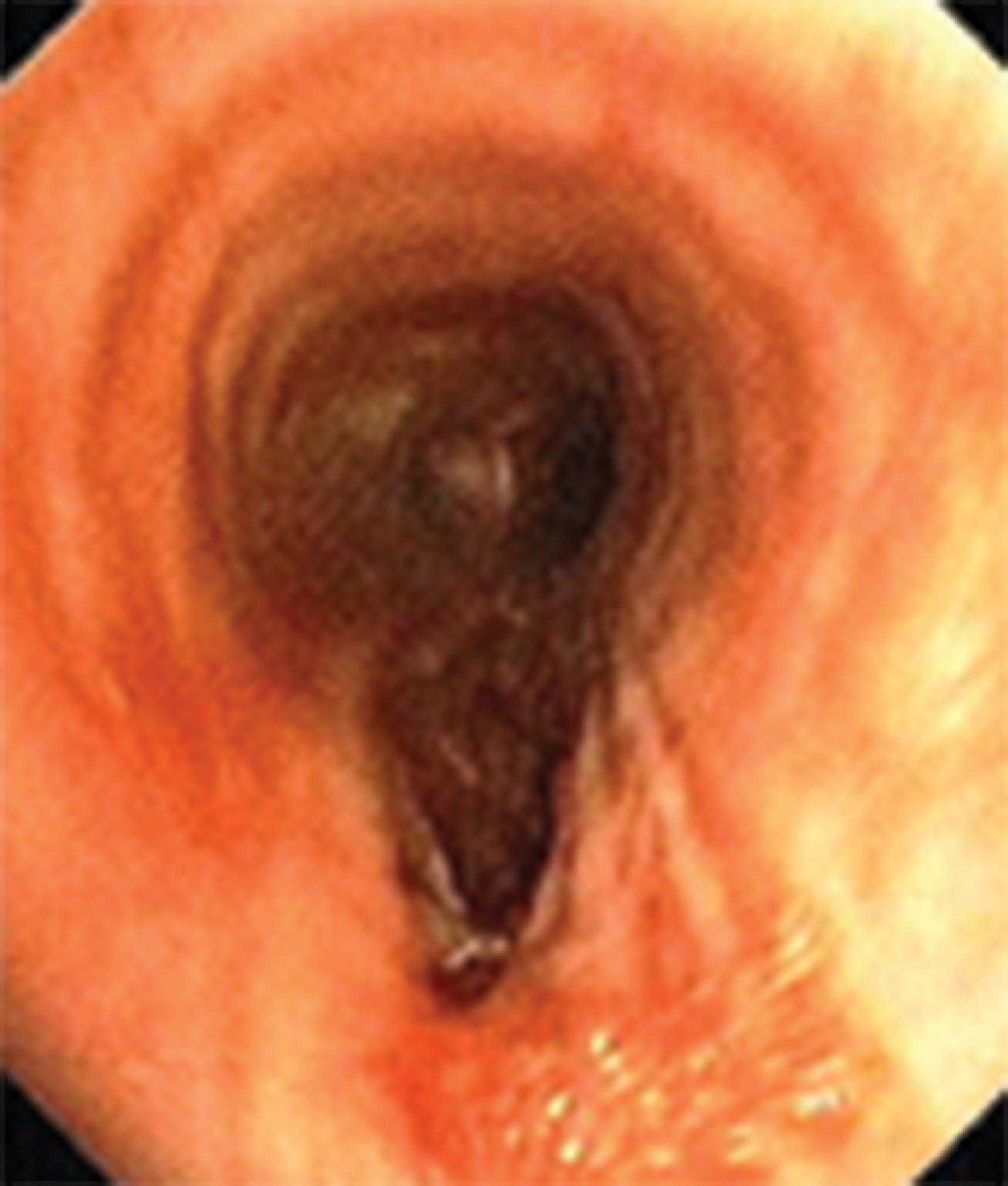 Fig. 44.4, Trauma along the posterior tracheal wall from intubation with a styletted endotracheal tube.