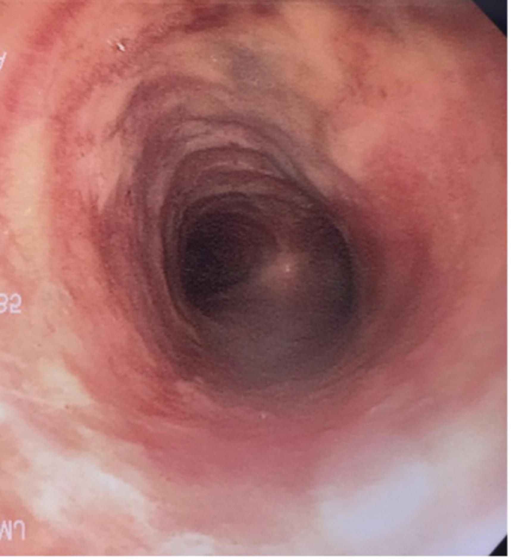 Fig. 44.7, Bronchoscopic exam prompted by continuous air leak revealing widening of the distal trachea (tracheomalacia).