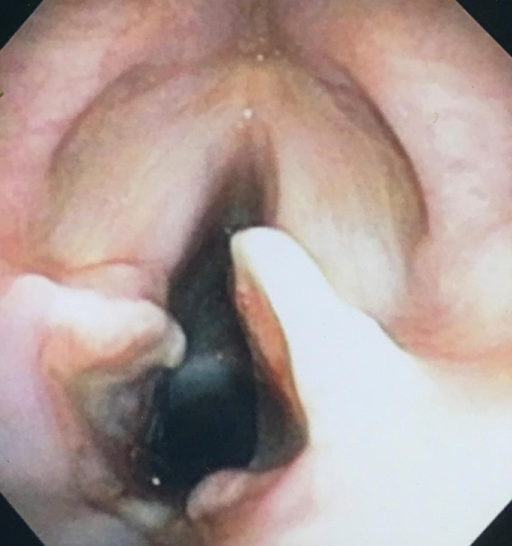 Fig. 44.9, Image captured during fiberoptic endoscopic evaluation of swallowing at bedside in the intensive care unit revealing significant true and false vocal cord edema, arytenoid edema, and a large posterior gap where the previous endotracheal tube was positioned for 6 days before extubation was achieved.