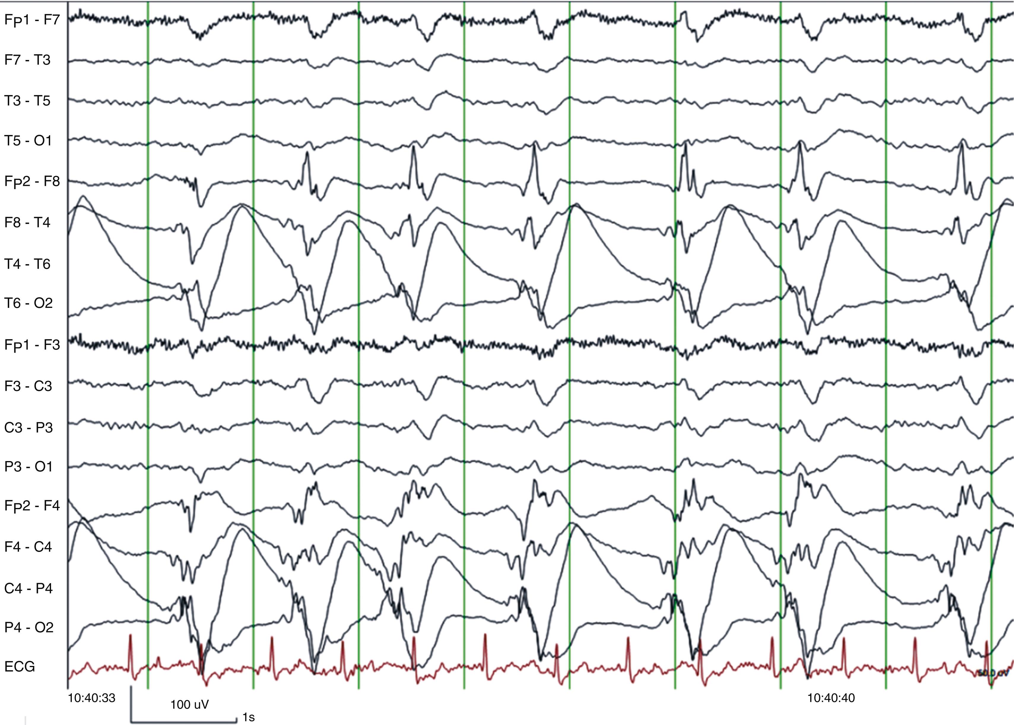 FIGURE 372-3, Focal right hemisphere nonconvulsive status epilepticus in a comatose patient with a large right hemisphere infarct.