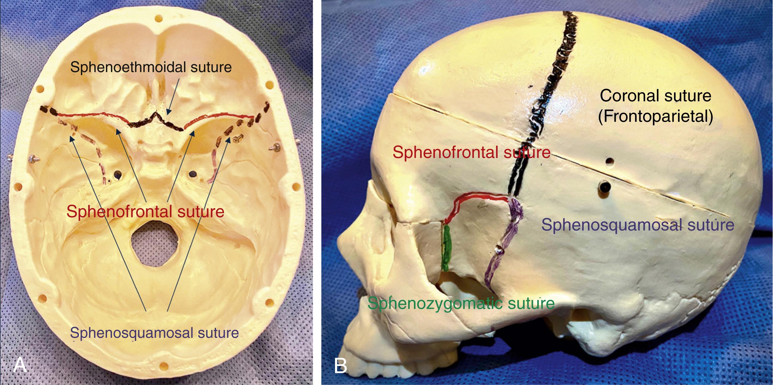 Fig. 2.1, (A) Birds view of skull base demonstrating sphenoethmoidal, sphenofrontal, and sphenosquamosal sutures. (B) Profile view of skull demonstrating coronal, sphenofrontal, sphenosquamosal, and sphenozygomatic sutures.