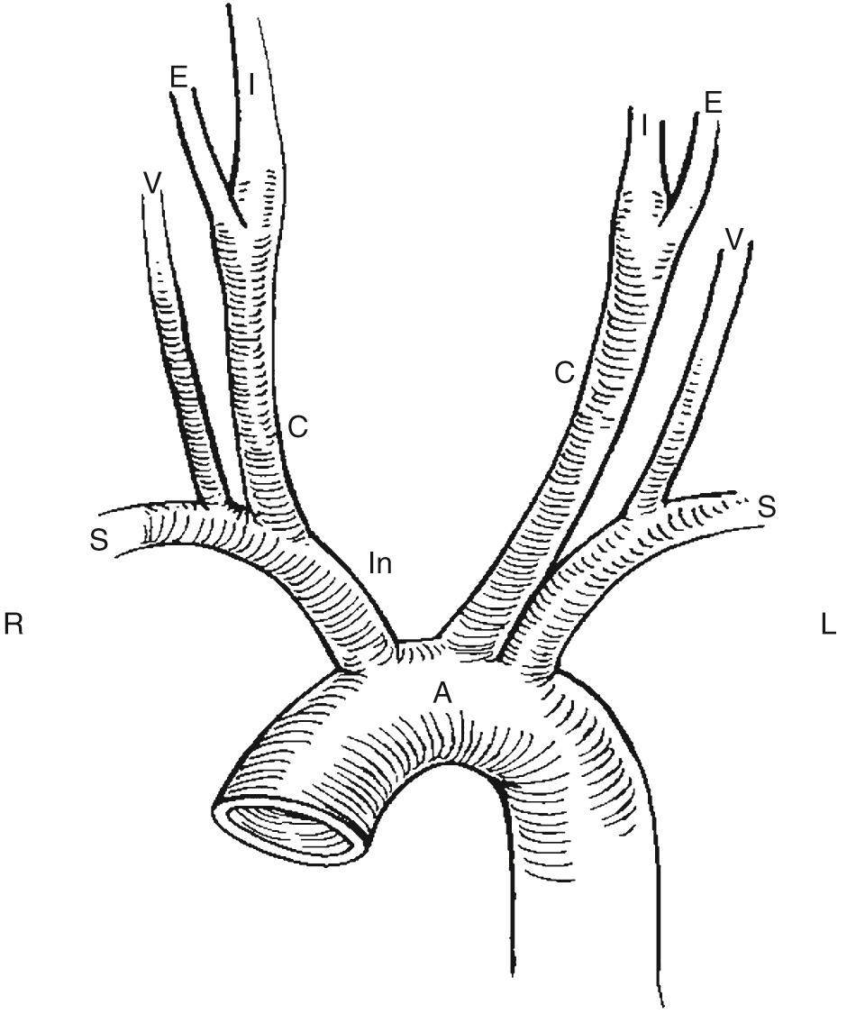 FIG. 26.1, Branches of Aortic Arch and Extracranial Cerebral Arteries.