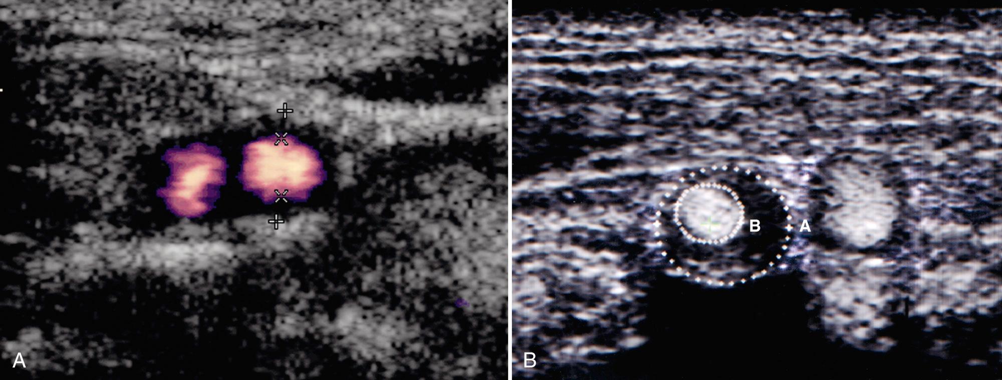 FIG. 26.12, Measurement of Carotid Artery Diameter.