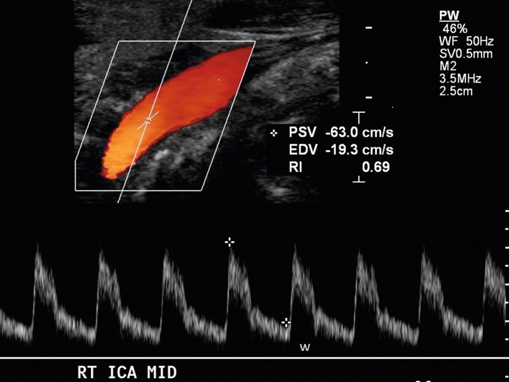 FIG. 26.13, Normal Internal Carotid Artery (ICA) Waveform.