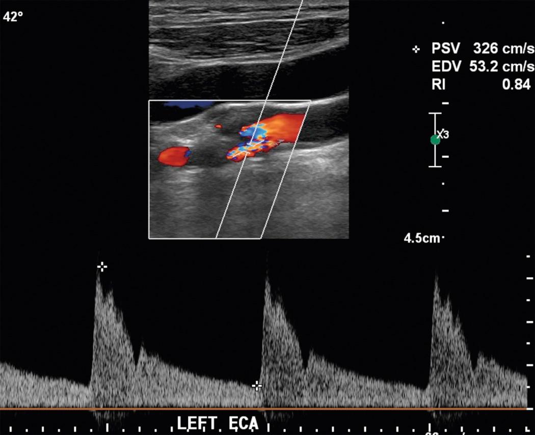 FIG. 26.18, High-Grade External Carotid Artery (ECA) Stenosis.