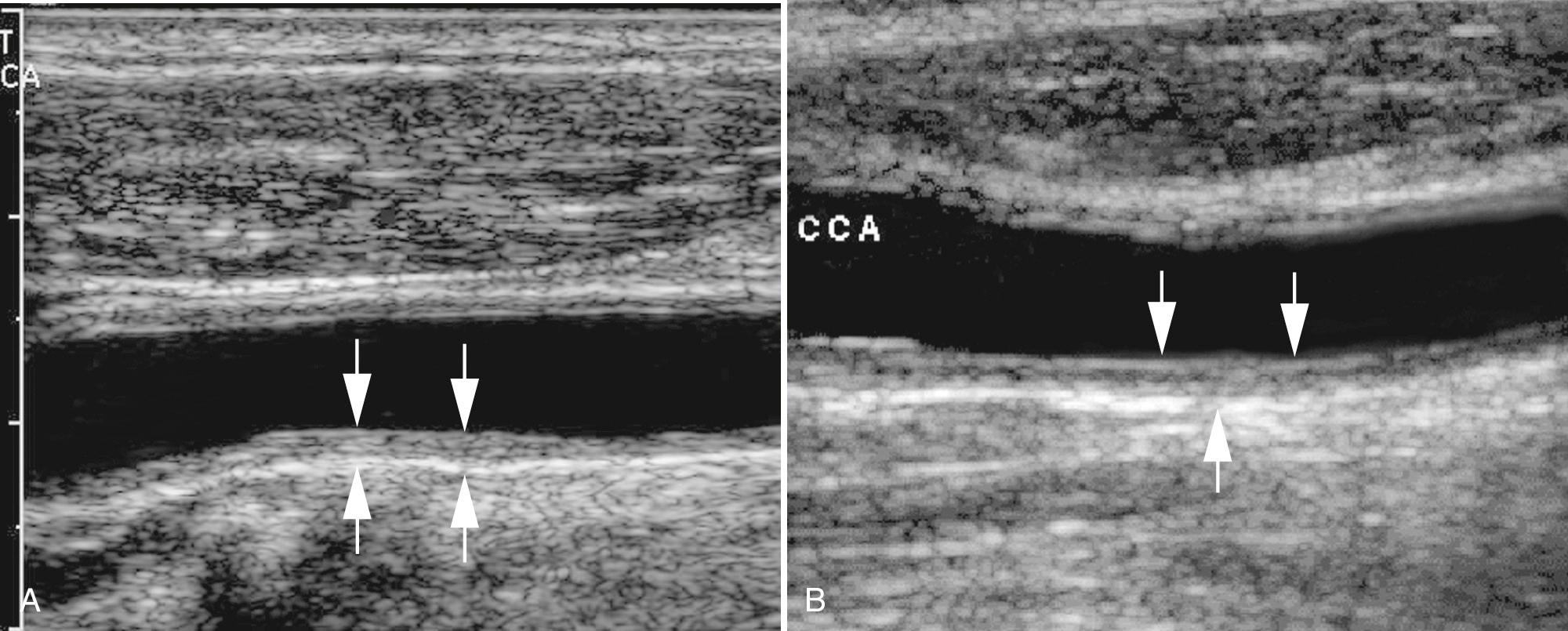 FIG. 26.6, Abnormal Intima-Media (I-M) Complex of Common Carotid Artery (CCA).