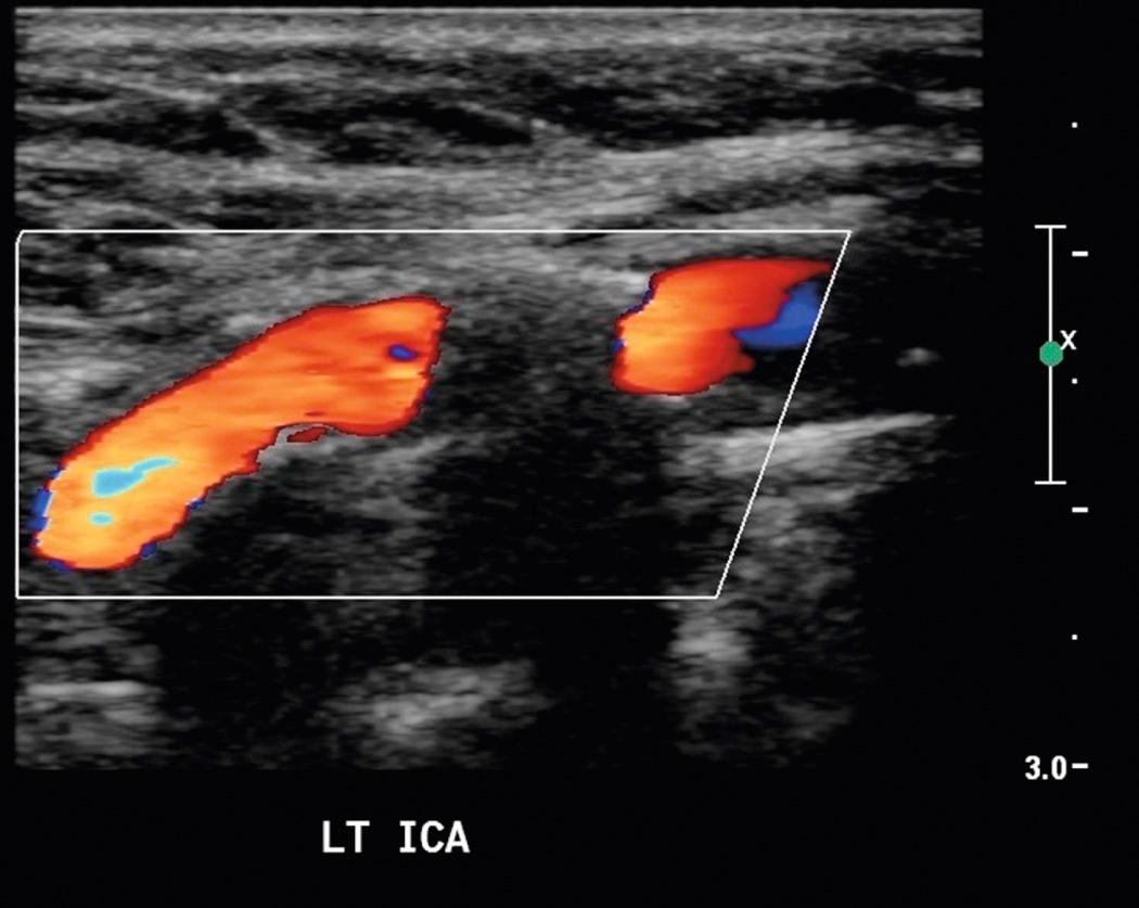 FIG. 26.8, Calcified Plaque.