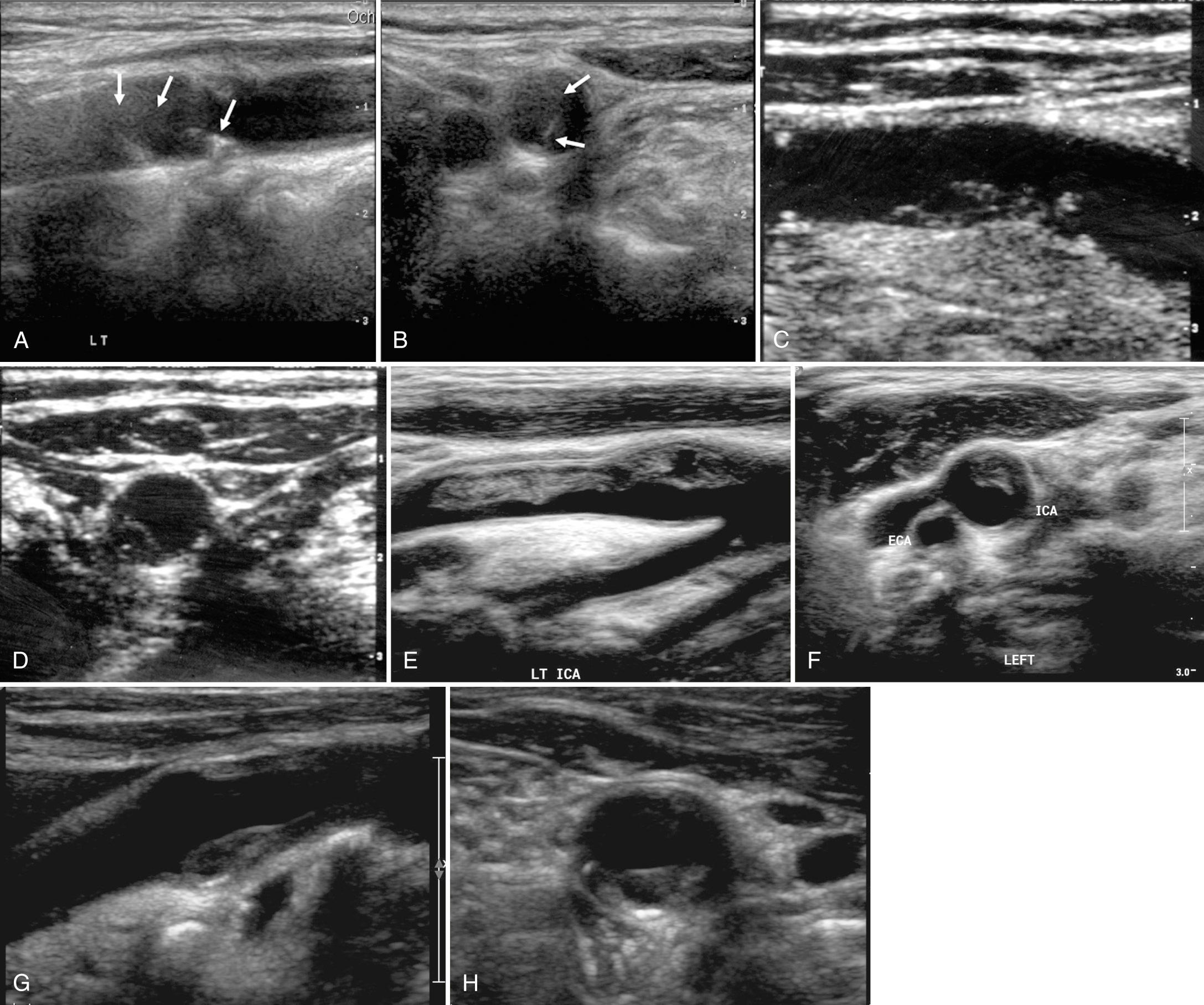 FIG. 26.9, Spectrum of Patterns of Heterogeneous Plaque in the Internal Carotid Artery (ICA).