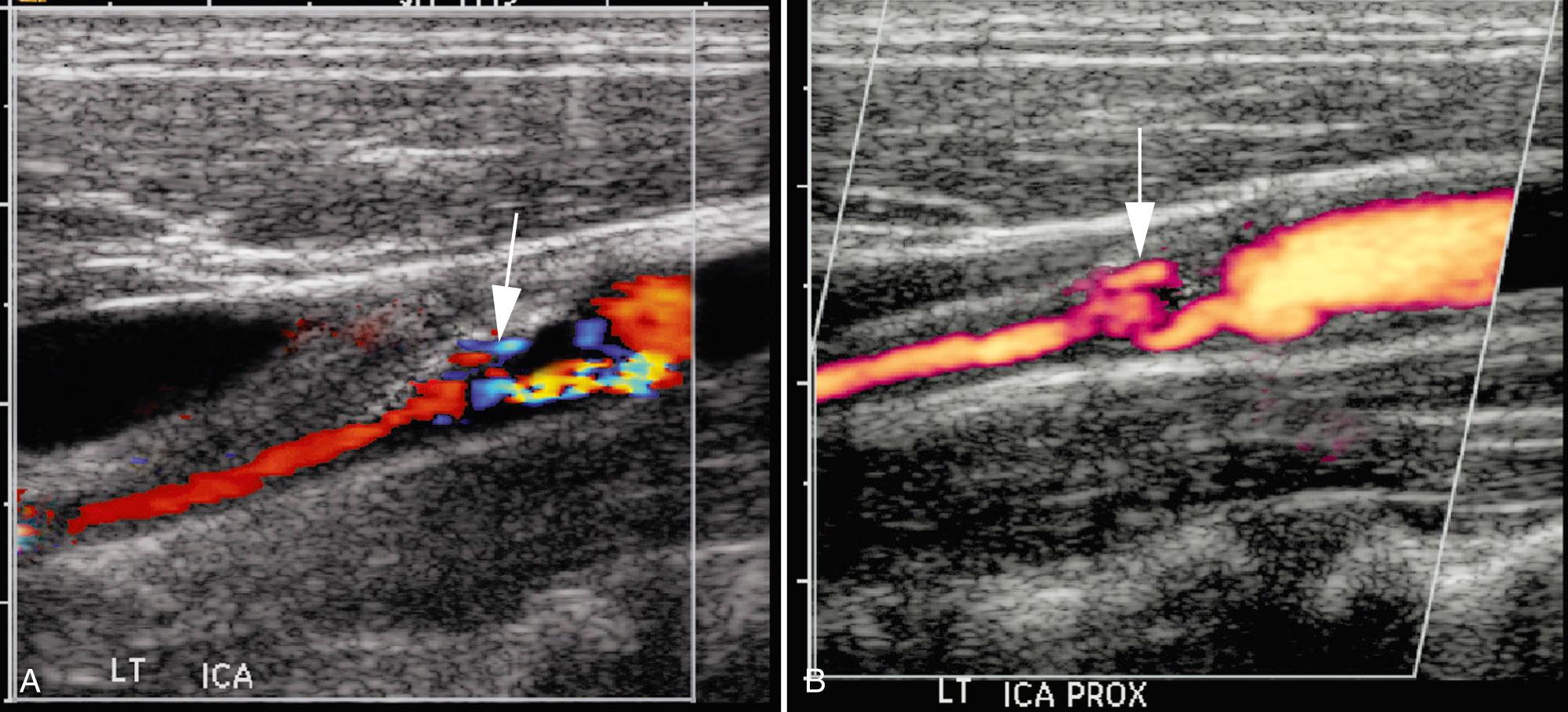 FIG. 26.10, Plaque Ulceration.