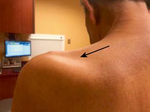 FIG. 33.1, Supraspinatus atrophy (arrow) .