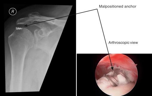 FIG. 33.11, Malpositioned anchor