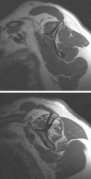 FIG. 33.12, Grades 2 and 4 Goutallier classification: Grade 0: Normal muscle Grade 1: Some fatty streaks Grade 2: Less than 50% fatty muscle atrophy (top) Grade 3: 50% fatty muscle atrophy (bottom) Grade 4: Greater than 50% fatty muscle atrophy (bottom)