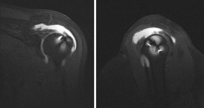 FIG. 33.13, Magnetic resonance arthrogram showing recurrent rotator cuff tear. Coronal image (left) , sagittal image (right) .