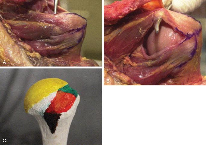 FIG. 33.16, (A) Posterior view of a cadaver showing infraspinatus and teres minor. (B) Dissected interval between infraspinatus and teres minor. (C) Model showing footprints of infraspinatus (red) and teres minor (black) , as well as supraspinatus (green).