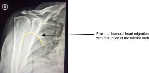 FIG. 33.9, Anteroposterior Grashey view: Define: Patient is rotated 40 degrees toward the affected side. Beam is directed to the glenohumeral joint. Evaluate: glenohumeral joint space, greater tuberosity for bony changes, proximal humeral head migration, location and types of implants used in prior repair.