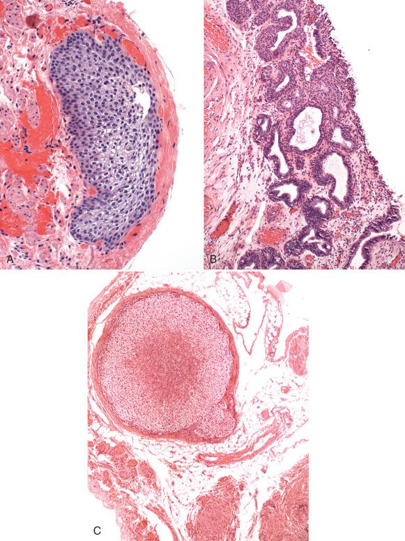 Fig. 21.11, A, Walthard cell rest. B, Reserve cells situated beneath the fimbrial columnar cells (lower) expand to give rise to the transitional cells (upper) in this tube. C, Ectopic adrenal tissue in the paratubal soft tissue. D, Focus of granulosa cells in the outer wall of the fallopian tube. E, At higher magnification. F, The calretinin stain is positive.