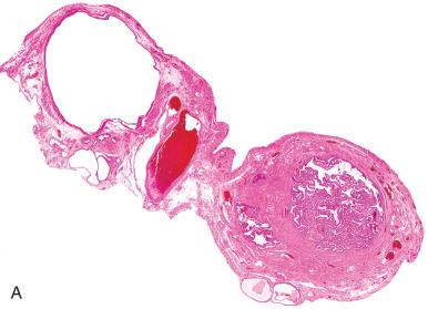 Fig. 21.12, A, Paratubal müllerian cyst (hydatid of Morgagni), suspended by a thin soft tissue pedicle. B, Cyst wall with rudimentary plicae. C, Ciliated lining epithelium.