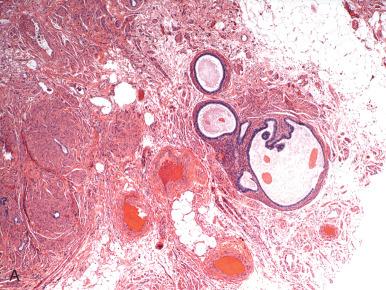 Fig. 21.13, A, Endosalpingiosis in the broad ligament adjacent to the round ligament. B, Endosalpingiosis in the round ligament, consisting of ciliated epithelium.