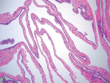 Fig. 21.14, A, Cystic adhesions. B, At higher power, there is focal transitional metaplasia.