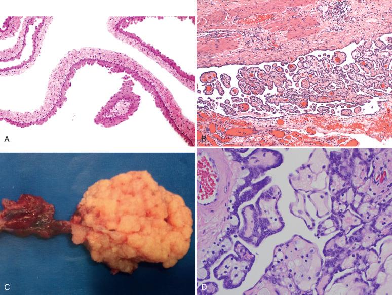 Fig. 21.15, A, Focal squamoid metaplasia of the lining epithelium of a mesothelial cyst. B, Papillary mesothelial hyperplasia (benign papillary mesothelioma). C, A large papillary mesothelioma on the distal fallopian tube. D, A microscopic view. There is no invasion of the underlying stroma.