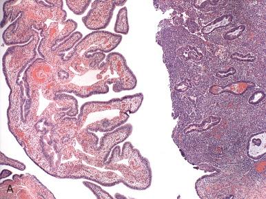 Fig. 21.17, A, Endometriosis in the tubal wall adjacent to the lumen. B, Older, more subtle lesion with scant hemosiderin in a fibrous matrix. C, Scant stroma and hemosiderin on the surface of the tube. A few plasma cells are seen (inset). D, Hemosiderin only is not diagnostic of endometriosis but in many cases will be all that can be found in the biopsy to indicate its possible presence.