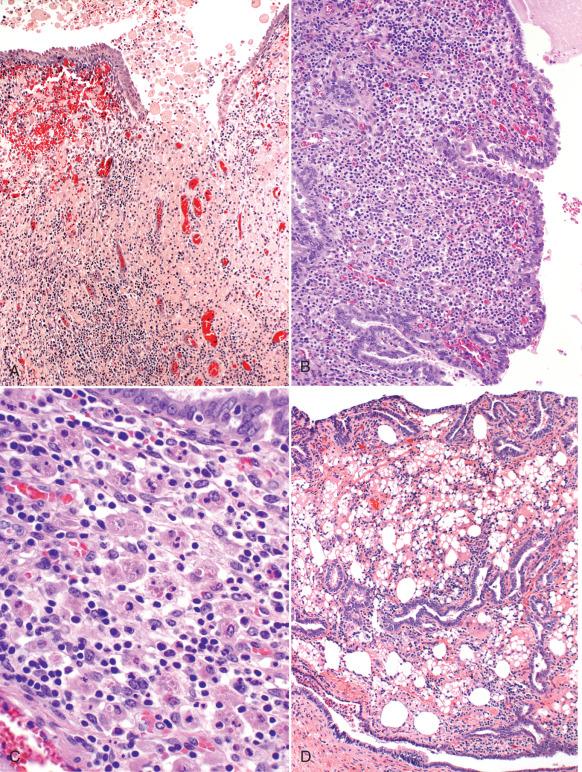 Fig. 21.19, A and B, Xanthogranulomatous salpingitis. The lamina propria is consumed by inflammatory cells; foamy histiocytes are present on the luminal surface (left). C, At higher magnification, the dominant cell population is mononuclear, with scattered foamy histiocytes. D, Granulomatous salpingitis associated with contrast (ethiodized oil [Lipiodol]) material, present here as microscopic spaces, signifying lipid droplets that have dissolved during processing.