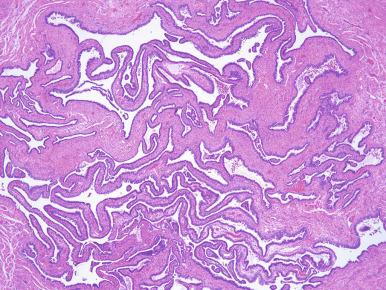 Fig. 21.21, Old follicular salpingitis is characterized by fibrous adhesions of plica with minimal residual inflammation.