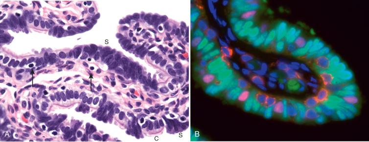 Fig. 21.3, A, High magnification of tubal mucosa. Darkly stained elongate nuclei of secretory cells (S) are prominent in this section, with nuclei protruding into the lumen, and are admixed with ciliated cells (C). These two cell types comprise over 90% of the tubal epithelium. Occasional lymphocytes are situated in the basal region, appearing as rounded nuclei (arrows). B, This immunofluorescent image of a tubal plica highlights secretory ( green, with PAX8) and ciliated ( red, with FOXJ1) cell nuclei. Note the presence of a third basal population highlighted by orange fluorescence of the cytoplasm with CD44. CD44 is considered to be a potential marker for stem cell characteristics.