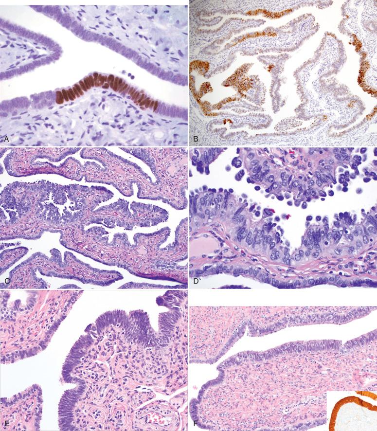 Fig. 21.6, A, Benign serous tubal epithelial lesion (so-called p53 signature). Note the focal intense staining for p53. B, Tubal section from a woman with Li Fraumeni syndrome displays multiple p53 signatures, a consequence of greater vulnerability to inactivation of the p53 gene in these women. C, Benign epithelial hyperplasia (type I secretory [stem] cell outgrowth). D, Note the presence of prominent ciliated differentiation. E and F, Benign epithelial hyperplasia (type II secretory cell outgrowth). These are distinctly endometrioid in appearance and contain altered expression of beta-catenin ( F, inset ). G, A type II secretory/stem cell outgrowth (SCOUT) with a squamous morule (atypical hyperplasias), indicating the presence of beta-catenin dysregulation. H, Type II SCOUTs with focal proliferative activity (left) are occasionally encountered. Coexisting endometrioid adenocarcinomas can occur with these but are rare.