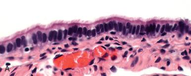 Fig. 21.5, Variations of mucosa in the fallopian tube of adults. A, Non-stratified, predominantly ciliated epithelium. B, Mixture of ciliated and secretory cells. C, Eosinophilic changes in the mucosa, occurring in the ciliated cells. D, Focal epithelial hyperplasia, seen in pregnancy in this case. The expanded population contains both ciliated and secretory cells.